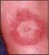 lyme disease picture rash